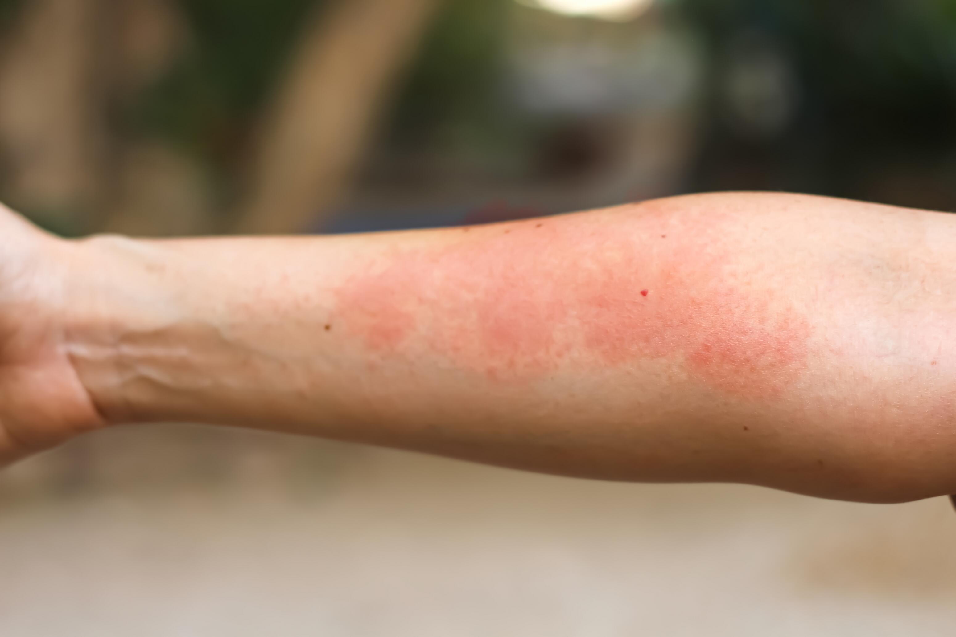 Arms with red eczema patches